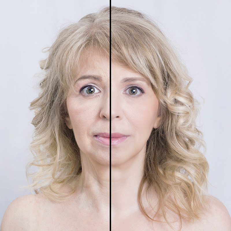 botox.jpg