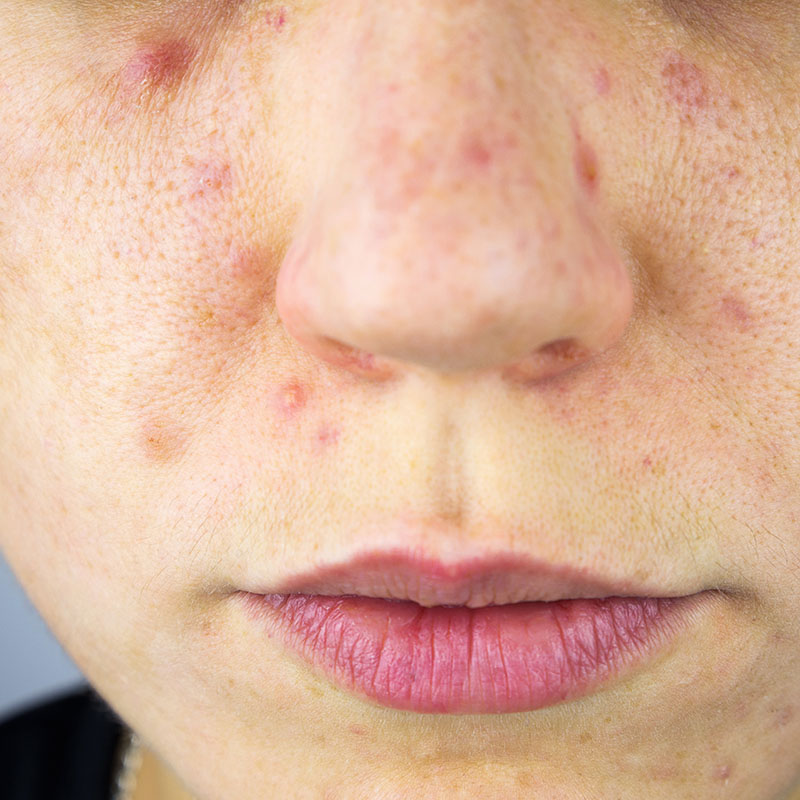 Young Woman with Acne Scars